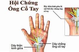 Mắc Hội Chứng Ống Cổ Tay Là Gì